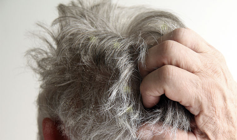 Cómo afecta la dermatitis seborreica al pelo y cuero cabelludo? - ITC  Medical